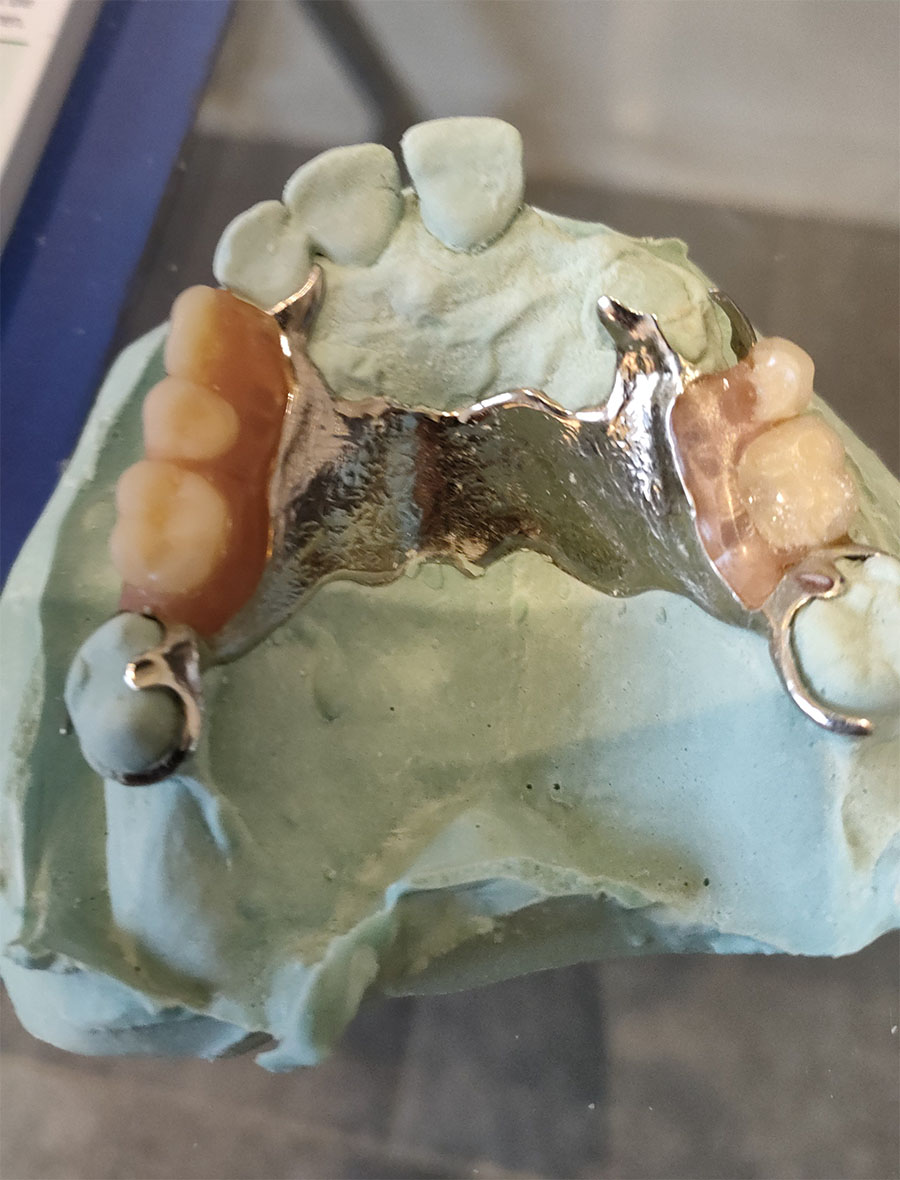 Fabrication de châssis prothétiques